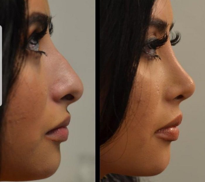 عمل-بینی-در-مشهد-5